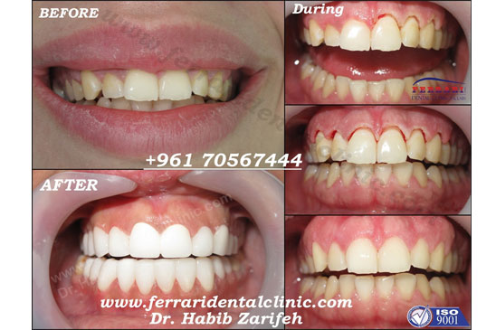 Dental Implants and gummy smile