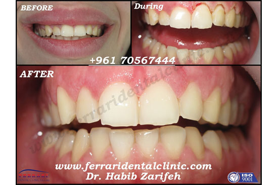 Dental Implants and gummy smile