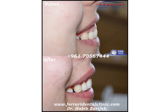 Gummy Smile correction for complicated cases