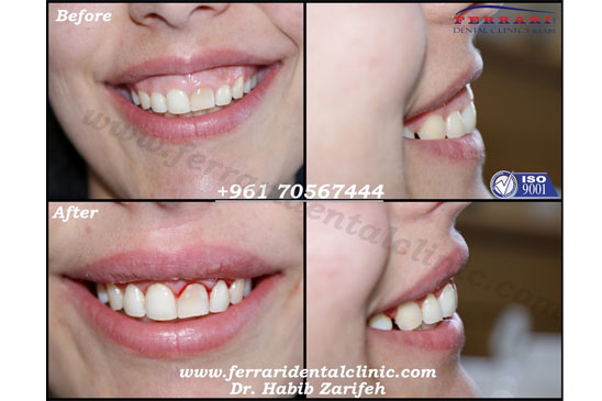 Gummy Smile correction for simple cases