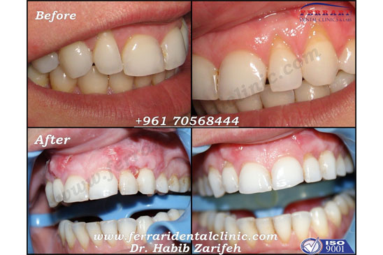 Gummy Smile Gum Graft