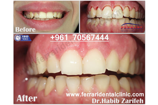 Dental Implants and gummy smile