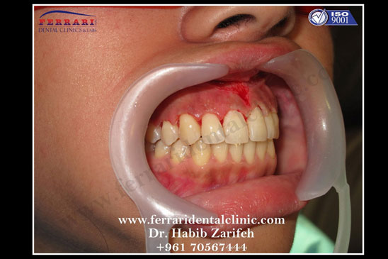 Frenectomy gummy smile