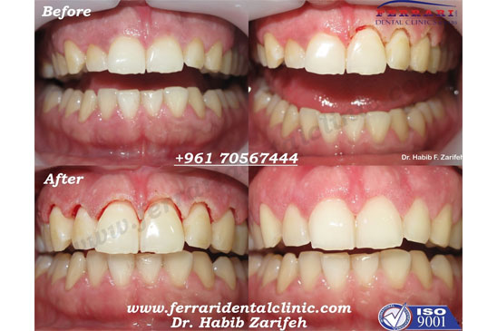 Gummy Smile correction for complicated cases