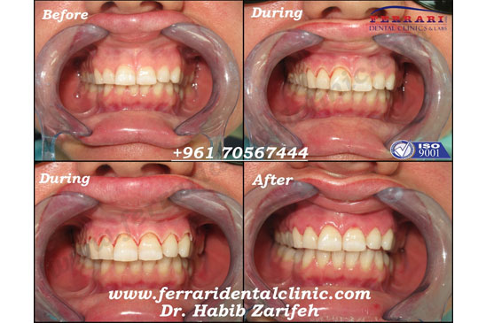 Gummy Smile correction for complicated cases