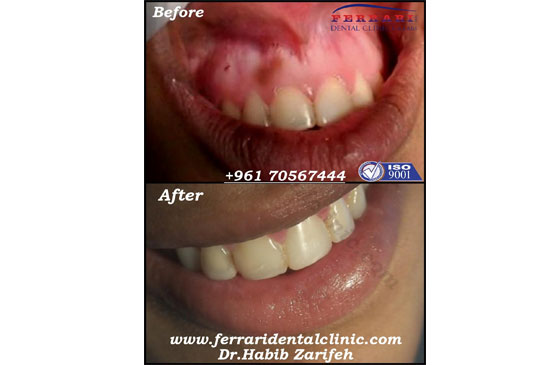 Gummy Smile Laser Gum Bleaching Melanin Depigmentation