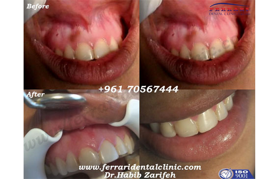 Dental Implants and gummy smile