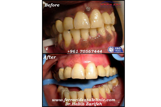 Gummy Smile Laser Gum Bleaching Melanin Depigmentation