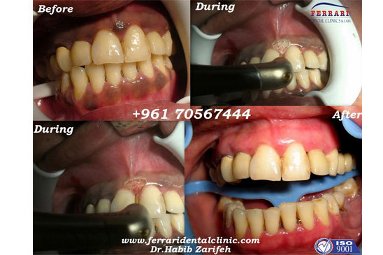 Gummy Smile Laser Gum Bleaching Melanin Depigmentation